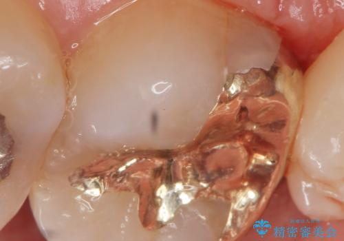 食べ物が詰まる 親知らずが原因の虫歯再発の症例 治療後