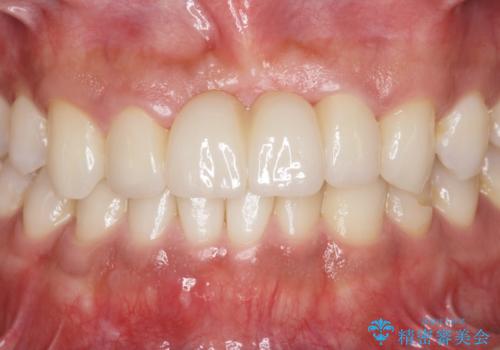 [前歯の歯根吸収]　前歯審美セラミックブリッジの製作の治療後