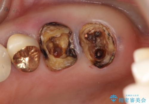 強い咬合力に対抗するメタルボンド補綴の治療中