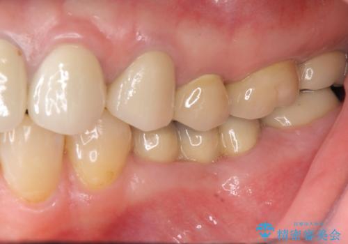 強い咬合力に対抗するメタルボンド補綴の症例 治療後