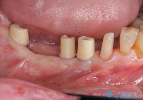 奥歯のインプラント治療の治療中