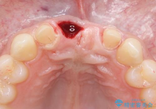 [前歯の歯根吸収]　前歯審美セラミックブリッジの製作の治療中