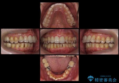 奥歯が割れてしまった　インプラントでかめるように　全体的な治療もの治療後