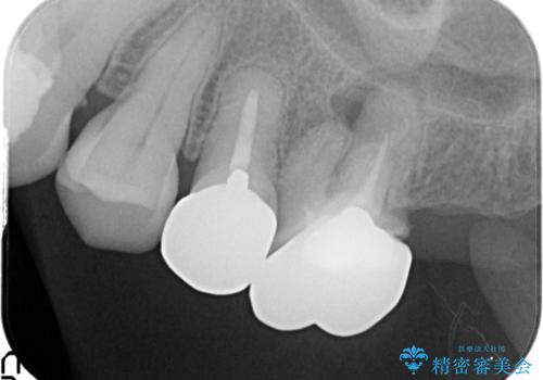 金属のかぶせ物をセラミックへ 根管治療からの再治療の治療前