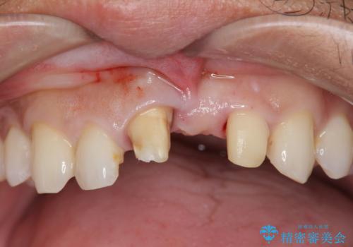[前歯の歯根吸収]　前歯審美セラミックブリッジの製作の治療中