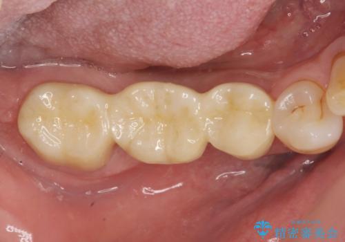 歯の破折 フルジルコニアブリッジ補綴の治療後