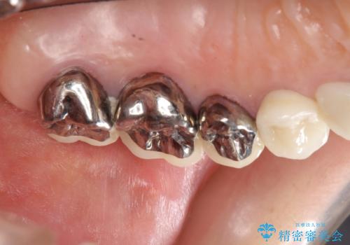 強い咬合力に対抗するメタルボンド補綴の治療後