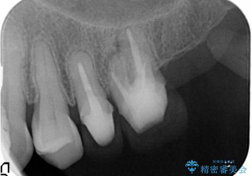 金属のかぶせ物をセラミックへ 根管治療からの再治療の治療中