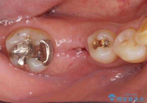 歯の破折 フルジルコニアブリッジ補綴の治療前