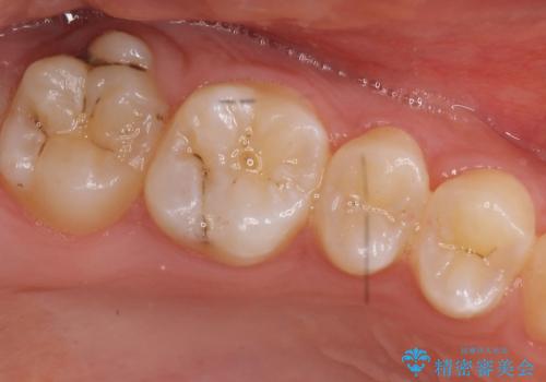 奥歯の虫歯　特殊な形をした歯の治療の症例 治療前
