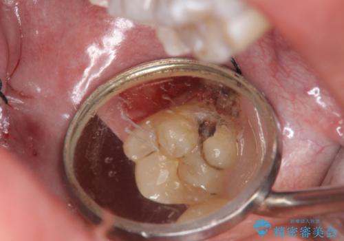 奥歯の虫歯　特殊な形をした歯の治療の治療中