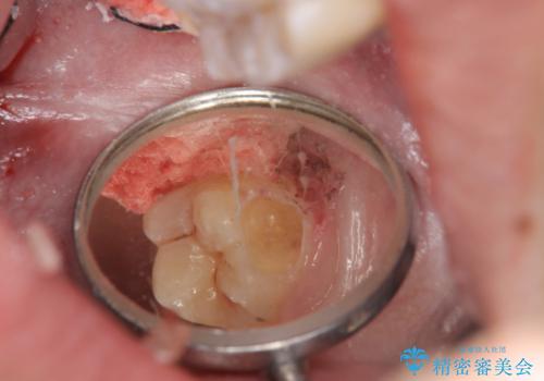 奥歯の虫歯　特殊な形をした歯の治療の治療中