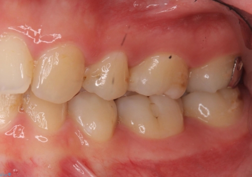 歯と歯の間の虫歯治療　セラミックインレーで治療の治療前