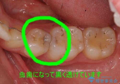 歯と歯の間の虫歯治療　セラミックインレーで治療