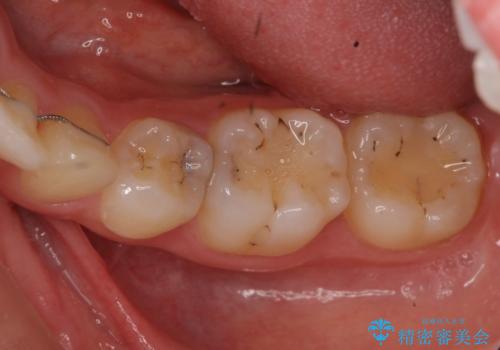 歯と歯の間の虫歯治療 セラミックインレーで治療の治療前