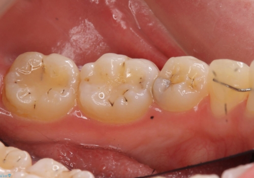歯と歯の間の虫歯治療 セラミックインレーで治療の症例 治療前