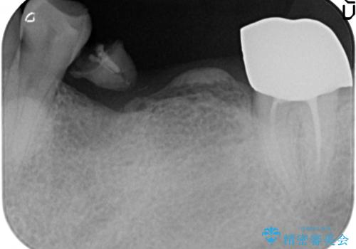 インプラント 失った奥歯の欠損補綴の治療前
