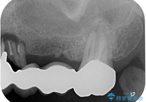 ブリッジの土台が割れて痛い インプラントによる補綴治療の治療前