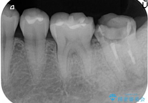 歯冠延長術 他院にてクラウンが入れられないと言われた歯の治療の治療前