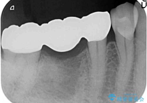 歯の破折　フルジルコニアブリッジ補綴の治療後