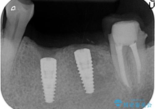インプラント 失った奥歯の欠損補綴の治療後