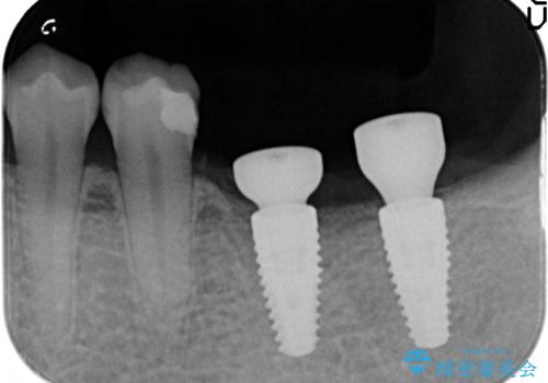 インプラント 失ってしまった奥歯の再建の治療後