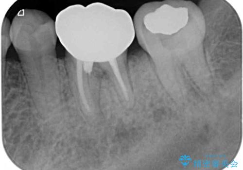 奥歯の虫歯 オールセラミッククラウンによる補綴治療の治療後