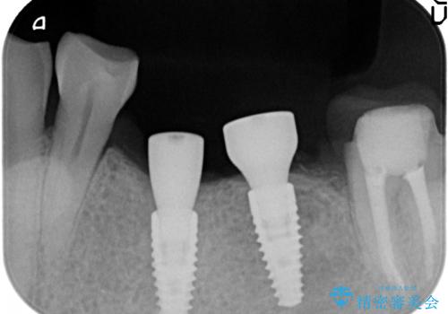 インプラント 失った奥歯の欠損補綴の治療後