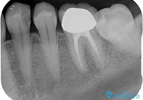 冷たいものがしみる セラミックインレーによるむし歯治療の治療前