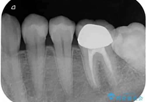 冷たいものがしみる セラミックインレーによるむし歯治療の治療後