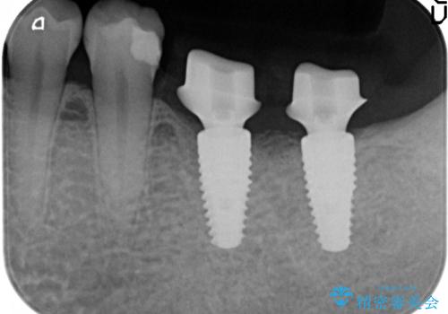 インプラント 失ってしまった奥歯の再建の治療中
