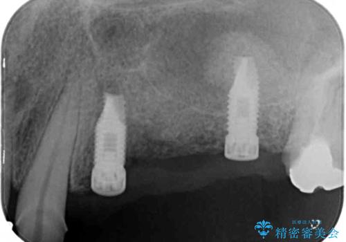 ブリッジの土台が割れて痛い インプラントによる補綴治療の治療中