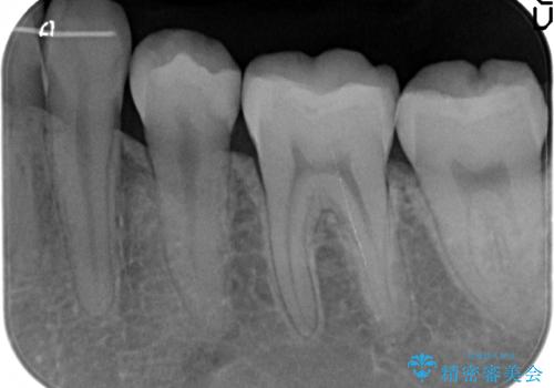 歯と歯の間の虫歯治療　セラミックインレーで治療の治療後