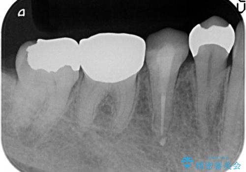 オールセラミッククラウン 違和感のある奥歯の治療の治療前