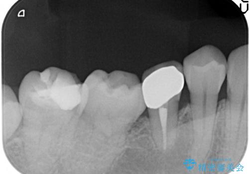 オールセラミッククラウン ズキズキ痛む虫歯の治療の治療後