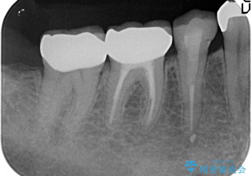 オールセラミッククラウン 違和感のある奥歯の治療の治療後