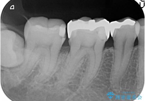 歯と歯の間に食べ物がつまる、金属を白くしたい、セラミックインレーにて修復の治療前