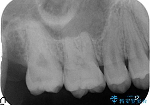 奥歯の虫歯　特殊な形をした歯の治療の治療前
