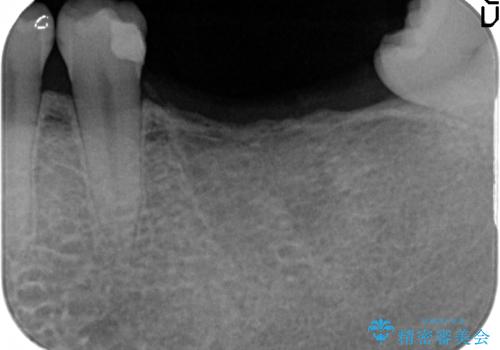 インプラント 失ってしまった奥歯の再建の治療前