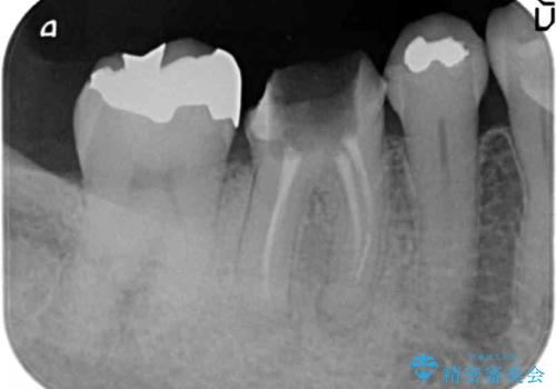 歯の破折 フルジルコニアブリッジ補綴の治療前