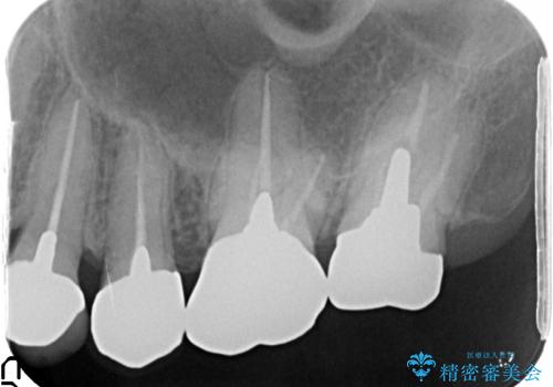 強い咬合力に対抗するメタルボンド補綴の治療前