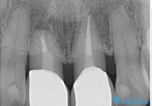 部分矯正とセラミック 前歯の審美治療の治療後