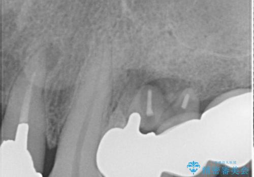 ブリッジの土台が割れて痛い インプラントによる補綴治療の治療前