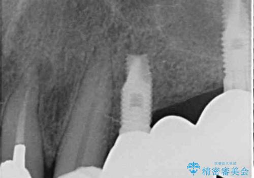 ブリッジの土台が割れて痛い インプラントによる補綴治療の治療後