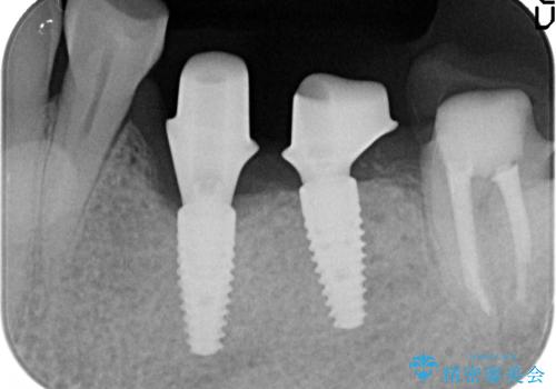 インプラント 失った奥歯の欠損補綴の治療中