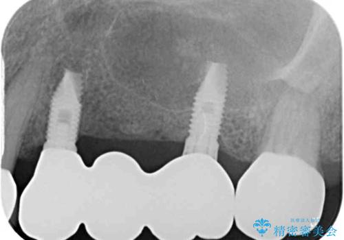 ブリッジの土台が割れて痛い インプラントによる補綴治療の治療後