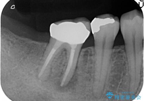 銀歯がしみる PGA(ゴールド)インレーへ 40代女性の治療前