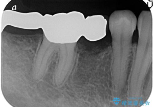 インプラント　咬めない奥歯の治療の治療前