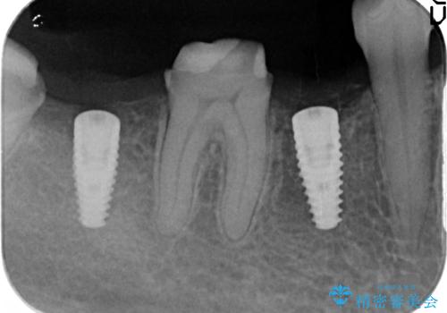 インプラント　咬めない奥歯の治療の治療後