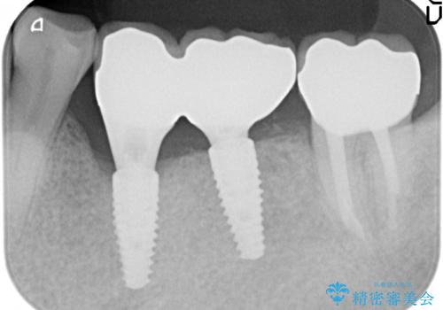 インプラント　失った奥歯の欠損補綴の治療後